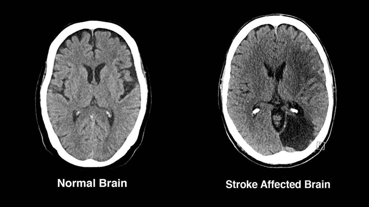 A CT scan showing a healthy brain next to a stroke affected brain.
