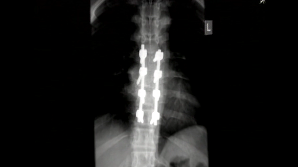 An x-ray of Scott's spine showing two plates and eight screws
